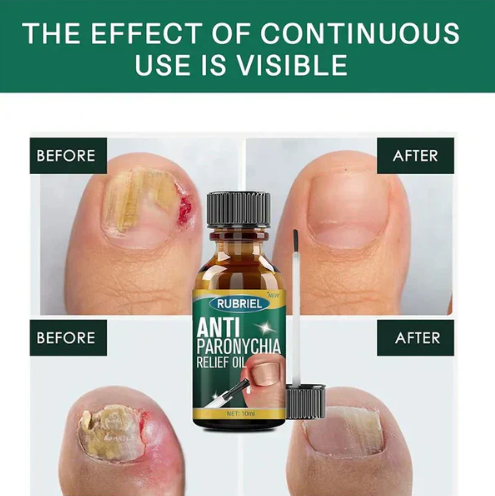 Anti Paronychia Relief Oil Buy 1 Get 1 Free