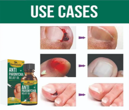 Anti Paronychia Relief Oil Buy 1 Get 1 Free