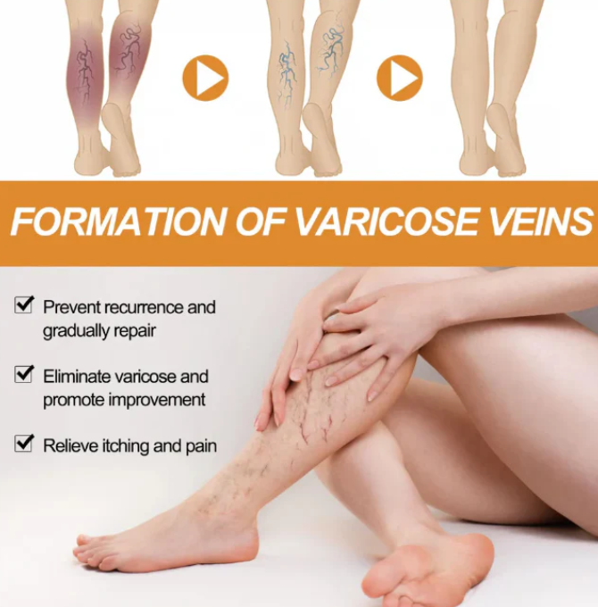 Turmeric Varicose Vein Relief Spray (BUY 1 GET 2 FREE 😍)