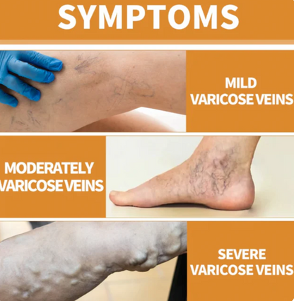 Turmeric Varicose Vein Relief Spray (BUY 1 GET 2 FREE 😍)