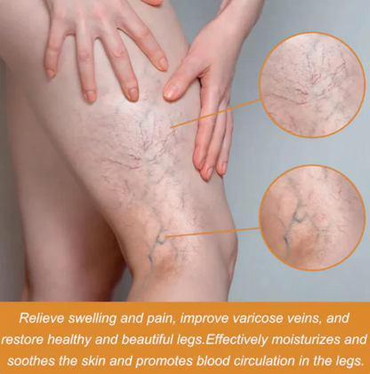 Turmeric Varicose Vein Relief Spray (BUY 1 GET 2 FREE 😍)