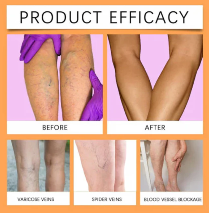 Turmeric Varicose Vein Relief Spray (BUY 1 GET 2 FREE 😍)
